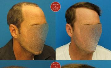 Hair transplantation surgery before and after images