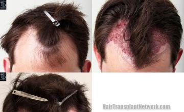 Hair transplantation surgery before and after photos