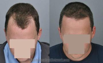 Top view before and after hair restoration results