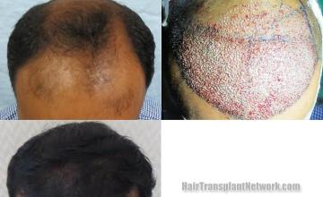 Hair transplantation surgery before and after images