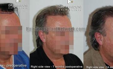 Hair restoration surgery before and after photos