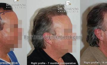 Hair transplantation surgery before and after images