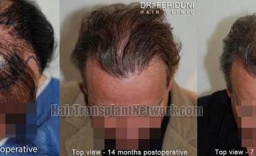 Hair transplantation surgery before and after photos