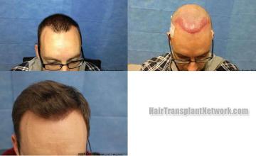 Hair transplantation surgery before and after images