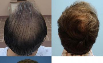 Hair restoration procedure before and after results