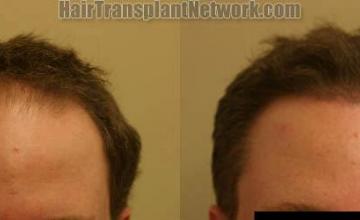 Hair restoration procedure before and after results