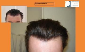 Front view - Before and after hair transplant surgery