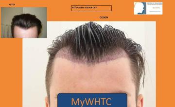 Before and after hair transplantation result photographs