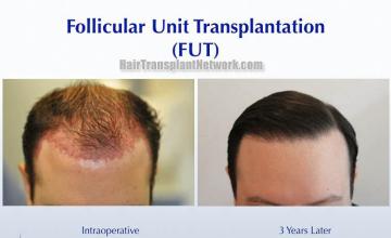 Hair transplant surgery before and after images