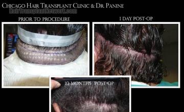 Hair restoration procedure before and after pictures