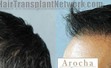 Hair transplantation surgery before and after images