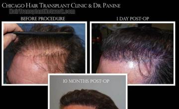 Hair transplantation surgery before and after pictures