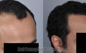 Hair transplantation surgery before and after pictures