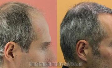 Hair transplantation surgery before and after images