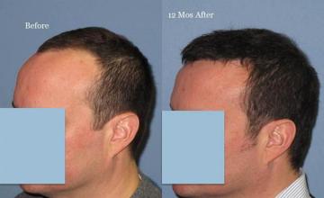 Hair transplantation surgery before and after images