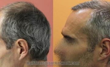 Hair transplantation surgery before and after pictures