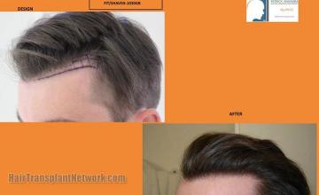 Hair restoration surgery before and after photos