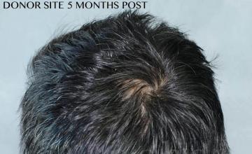 Hair restoration surgery before and after photos