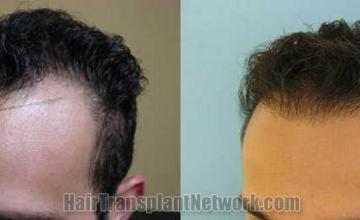 Hair transplantation surgery before and after photos