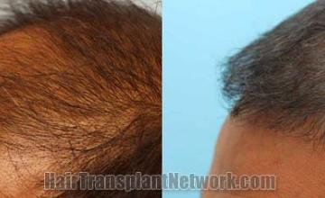 Hair transplantation surgery before and after images