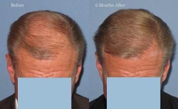 Top view - Before and after surgical hair replacement