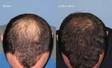 Top view before and after hair restoration results