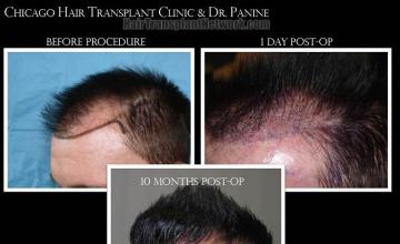 Hair transplantation surgery before and after pictures