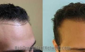 Hair restoration procedure before and after results