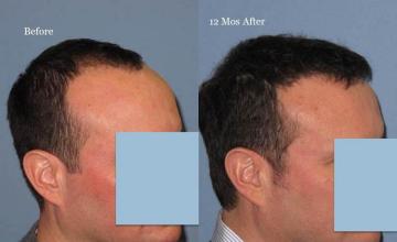 Hair transplantation surgery before and after photos