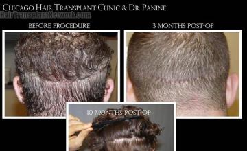 Hair transplantation surgery before and after pictures