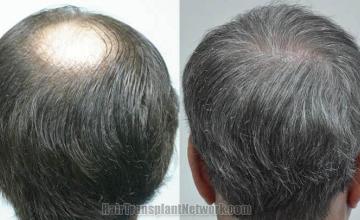 Hair restoration procedure before and after pictures