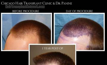 Hair restoration procedure before and after pictures