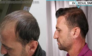 Hair restoration procedure before and after pictures