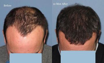 Hair restoration procedure before and after pictures