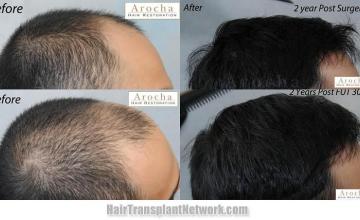 Hair transplantation surgery before and after pictures