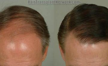 Hair transplantation surgery before and after pictures