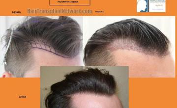 Hair transplantation surgery before and after images