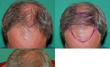 Hair transplantation surgery before and after images