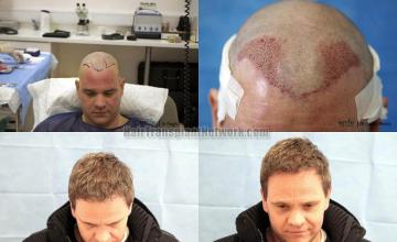 Hair restoration procedure before and after pictures