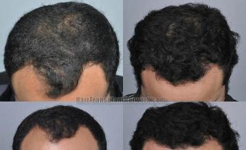 Hair transplantation surgery before and after images