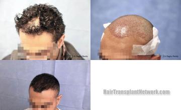 Hair transplantation surgery before and after images