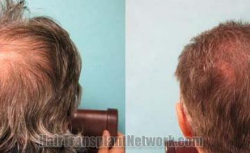 Hair restoration procedure before and after pictures