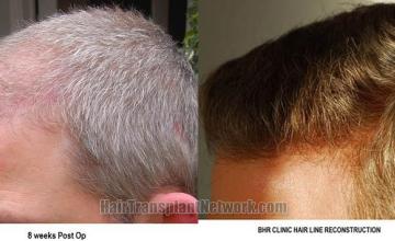 Hair transplantation surgery before and after pictures