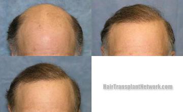  before and after images