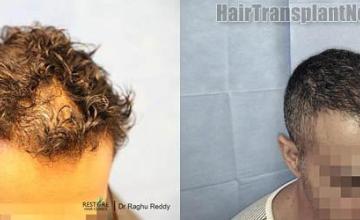 Hair transplantation surgery before and after photos