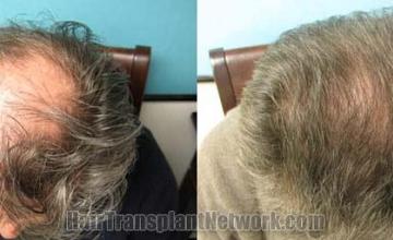 Hair transplantation surgery before and after pictures