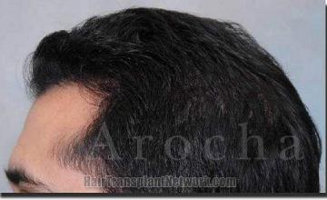 Hair restoration procedure results