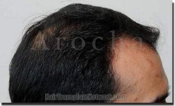 Hair restoration procedure results