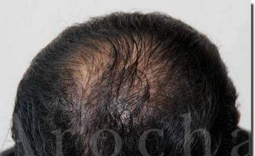 Hair restoration procedure results