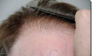 Hair restoration procedure results